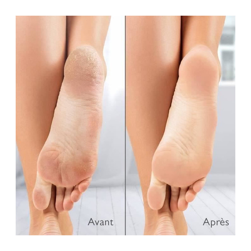 Silk'n Vacupedi Electric Callus Remover with Built-in Suction and 2 Fi