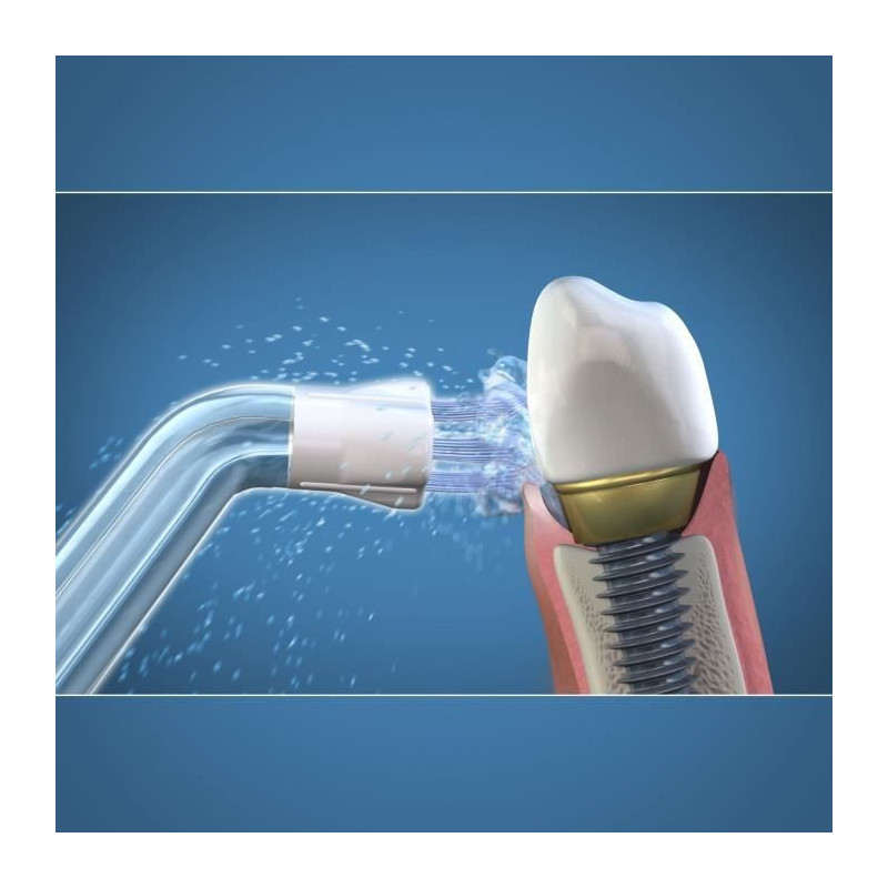 Waterpik Plaque Seeker Oral Irrigator Tip - Plaque Seeker