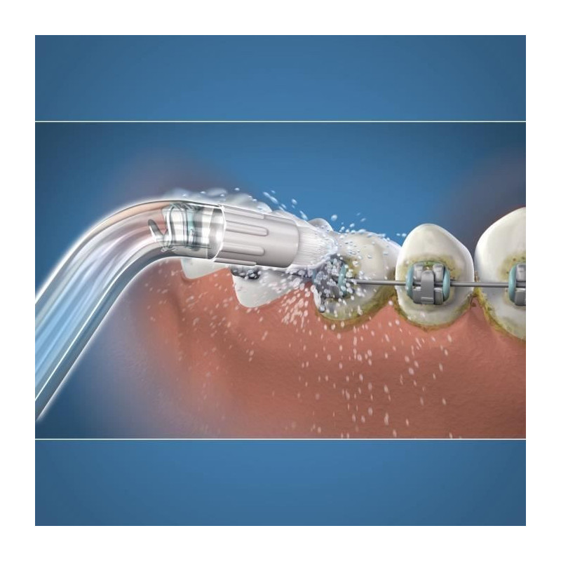 Embout Hydropulseur - WATERPIK - Orthodontique - Élimine la plaque -